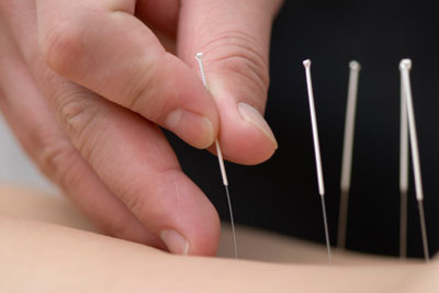 Akupunktur Nadeln