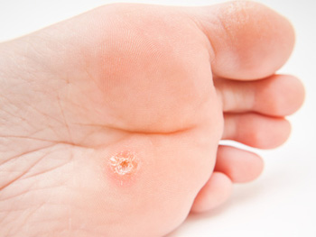 Eine typische Warze unter dem Fuß bereitet eventuell Schmerzen beim Gehen.